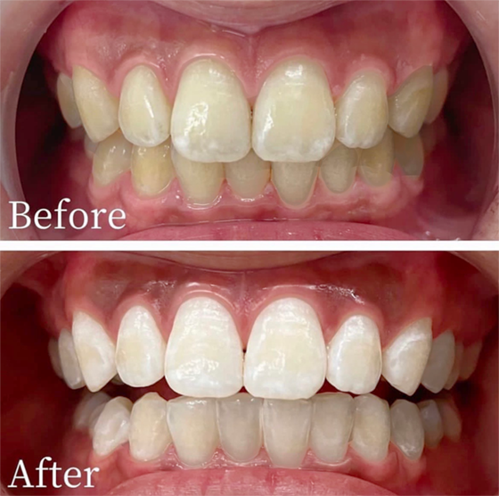 過酸化水素1回 ビフォーアフター