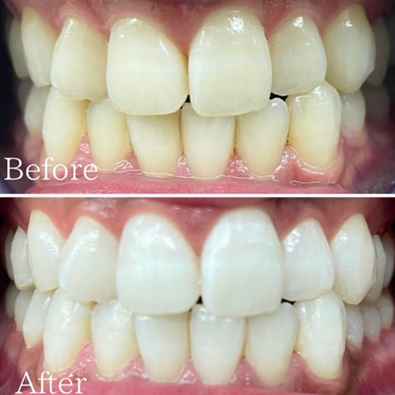 酸化チタン1回 ビフォーアフター