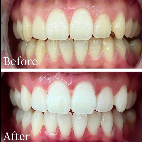 酸化チタン3回 ビフォーアフター