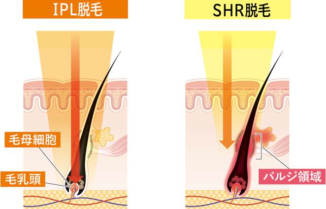 IPL＆SHR脱毛